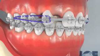 Missing Upper Laterals [upl. by Joshia]