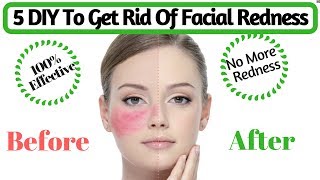 Natural Tips To Get Rid Of Facial Redness  How to Cure Red Irritated Skin  AVNI [upl. by Lipps]