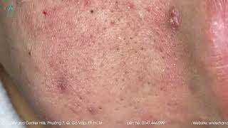 Big Cystic Acne Blackheads Extraction Blackheads amp Milia Whiteheads Removal Pimple Popping [upl. by Drahsar459]