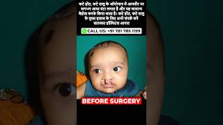 Free Cleft Lip and Palate Surgery at Saraswat Hospital Agra [upl. by Shiekh352]