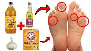 14 Proven Home Remedies For Corns amp Callus Removal THAT WORK [upl. by Htederem]