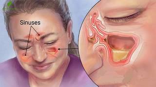 Conoce Como Puedes Eliminar Todo El Moco Y La Flema De Tu Garganta Y Pulmones [upl. by Stoecker]