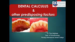 CALCULUS amp OTHER PREDISPOSING FACTORS [upl. by Alil433]