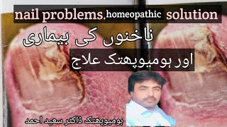 ناخنوں کی بیماری اور علاج nail problems Homeopathic solution [upl. by Eirok]