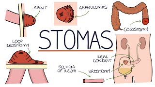 Understanding Stomas Colostomy Ileostomy Urostomy and Gastrostomy [upl. by Baldridge]