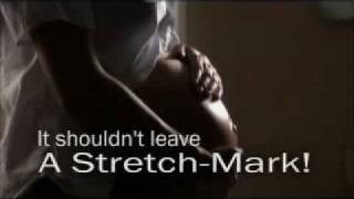 Stretch Marks After Pregnancy [upl. by Geldens]