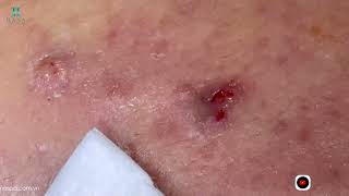 Big Cystic Acne Blackheads Extraction Blackheads amp Milia Whiteheads Removal Pimple Popping [upl. by Hecht20]