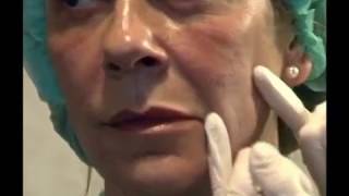 Aumento de pómulos mejillas y recuperación del contorno facial  Tratamiento Facial [upl. by Noirad386]