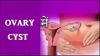 Ovary में Cyst या बच्चे न होना तो करे यह रामबांड उपाय  Ovary Cyst Treatment [upl. by Ranita]