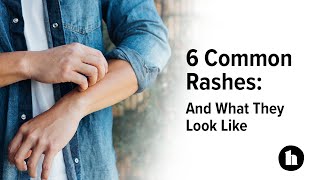 6 Common Rashes And What They Look Like  Healthline [upl. by Nivar]