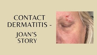 Contact Dermatitis  Joans Story [upl. by Akitan399]