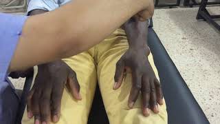 Rheumatoid hand examination دعبدالرؤوف بن يوسف [upl. by Emogene812]