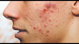 Mabisang Paraan Para Matanggal ang Pimples o Tigyawat– by Doc Katty Go Dermatologist 33b [upl. by Jamila]