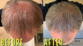 AMAZING BEFOREAFTER MICRONEEDLING RESULTS FOR HAIR GROWTH [upl. by Naeerb]