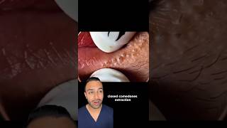 Your lip balm might be causing this Blackheads removal  Dr Somji reacts [upl. by Dyan]