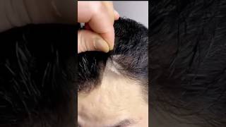 9899746489Natual Hair patch in Delhi viral explore natural hairpatch delhi amazing look [upl. by Eseeryt]