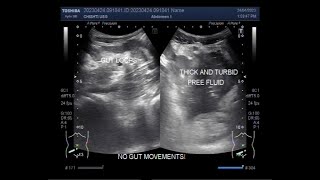 Intestinal obstruction with Perforation [upl. by Strawn]