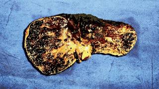 A Family Ate 1 Year Old Frozen Leftovers For Breakfast This Is What Happened To Their Organs [upl. by Sug662]