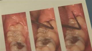 How To Alleviate Infected Wisdom Tooth [upl. by Emerej]