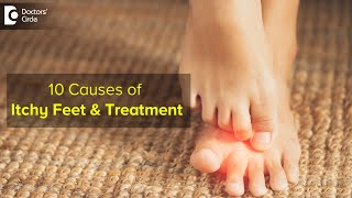 10 CAUSES OF ITCHY FEET How to get relief  Right Treatment  Dr Urmila Nischal Doctors Circle [upl. by Anuqahs]