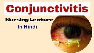 Eye Infection Conjunctivitis Pink Eye  Why is eye Infection Spreading in India fact short [upl. by Noyr]