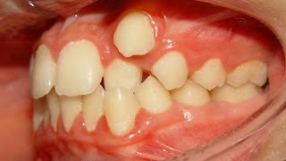 Orthodontic Treatment of Ectopic Upper Canine  No Extraction Salah 12yrs [upl. by Neelrahs985]