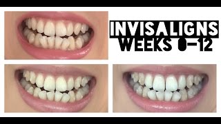 Invisalign Journey Weeks 012  YayForAmy [upl. by Oivalf]