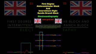 Electrocardiography  First Degree Atrioventricular Block And Intermittent Right Bundle Branch Block [upl. by Ttegdirb]