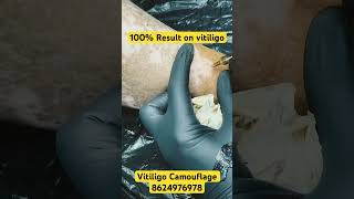 Vitiligo Micropigmentation TreatmentFor Contact 8624976978 vitiligoindia vitiligo safeddaagkailaj [upl. by Martinson]