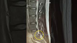 Lumbar Disc Herniation recovery at home discherniation discbulges backpain gym sciatica l5s1 [upl. by Frasch]