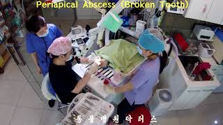 Periapical Abscess Broken Tooth 치첨농양 [upl. by Shute]