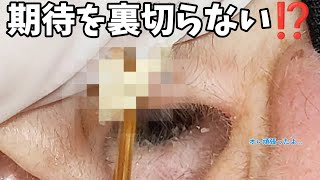 【耳掃除】104 耳かき 〜両耳バージョンまた右耳から……〜 earwax [upl. by Neelear]