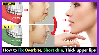 7 Steps How to Fix Overbite small chin big thick upper lip without braces naturally [upl. by Johna46]