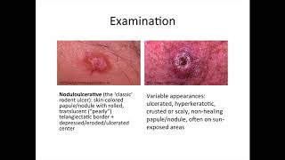 Dermatology  basal cell carcinoma and squamous cell carcinoma [upl. by Ladnor]