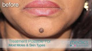 Mole Removal Surgery for Best Results at London amp Bristol Clinics [upl. by Arim612]