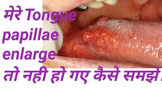 Tongue papillae enlarge हो गए यह कैसे समझे Tongue papillae location folliate circumvallet papillae [upl. by Sucramrej]