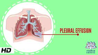 Pleural Effusion Causes Signs and Symptoms Diagnosis and Treatment [upl. by Ajnin707]