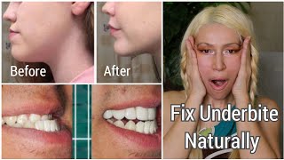 How To Fix An Underbite Naturally  Correcting Protruding Jaw and Chin  Jaw Exercises [upl. by Kerge]