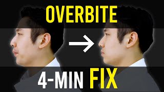 Overbite amp Overjet Fix｜Facial Asymmetry Correction｜Corrective Exercises [upl. by Geibel]