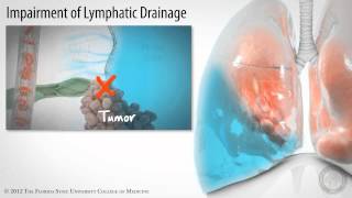 Pleural Space Part 3 of 3 Pleural Effusions HD [upl. by Nella]