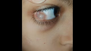 Hidden Swelling in eyes 👀  condition explained indetail eyecareoptom5506 eye eyelid swelling [upl. by Sivle410]