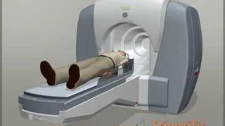 Neurology animation  Gamma Knife Surgery [upl. by Godbeare233]