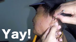 Elderly Mans Earwax Removed Using Hydrogen Peroxide As Ear Wax Softener [upl. by Pevzner]