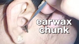 Girls Earwax Chunk Removal [upl. by Soraya202]