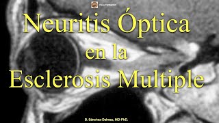 Neuritis Óptica en la Esclerosis Multiple [upl. by Nolaf]