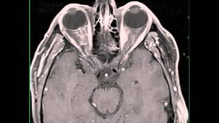 Optic Neuritis [upl. by Attenauqa]