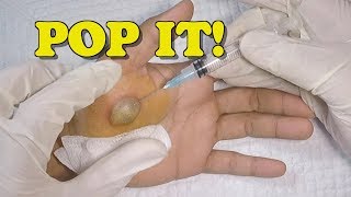 Popping a Huge Hand Blister [upl. by Adaynek]