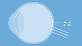 Wat is Macula Degeneratie MD  Oorzaak en vervolgstappen [upl. by Tesler]