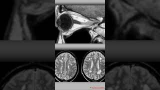 Diagnóstico de la neuritis óptica neuritis neuritisoptica [upl. by Bloem]