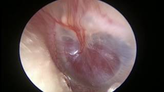 Endoscopic finding of Pulsatile glomus tympanicum [upl. by Anohr696]